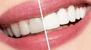 Teeth Whitening